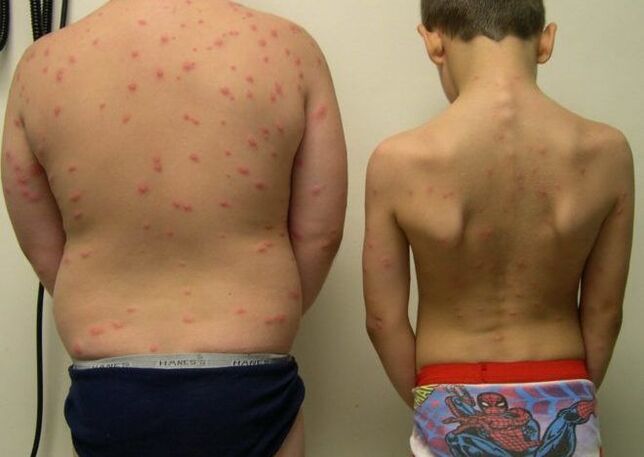 Rash on the skin with worms