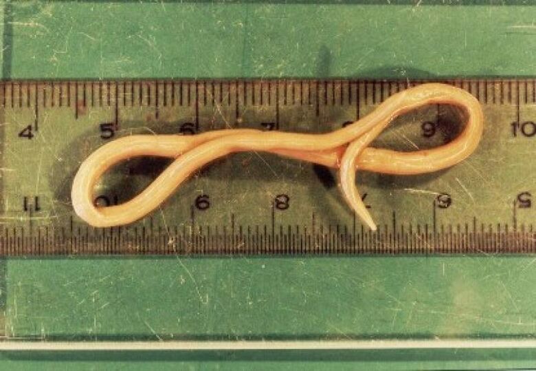 a roundworm parasite from the human body