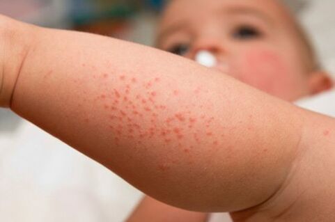 Allergy as a symptom of the presence of worms in a child