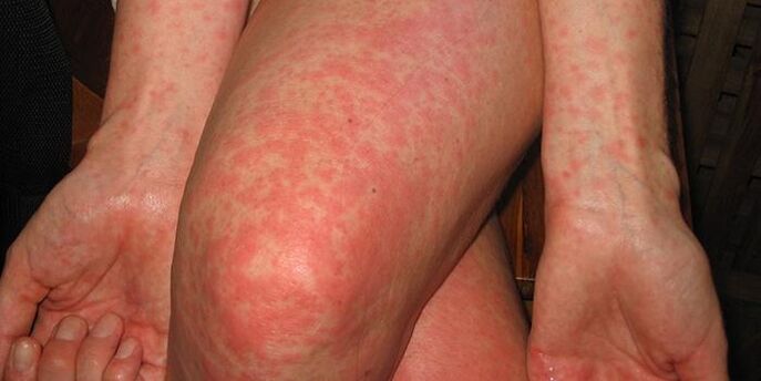 signs of parasites in the body